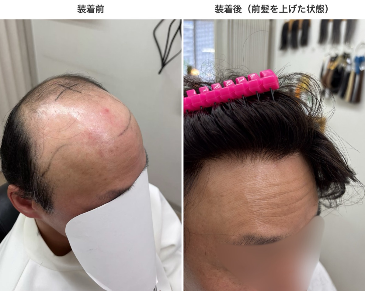 生え際ネットの装着前と装着後の比較。装着後は前髪を上げても生え際が自然に見える