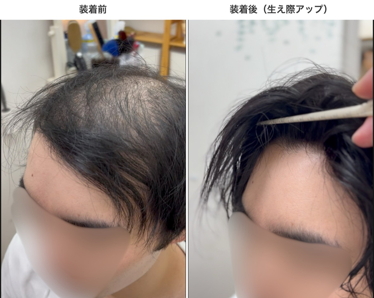 裏植えの装着前と装着後の比較（生え際アップ）。正面から見てもウィッグの縁が見えない