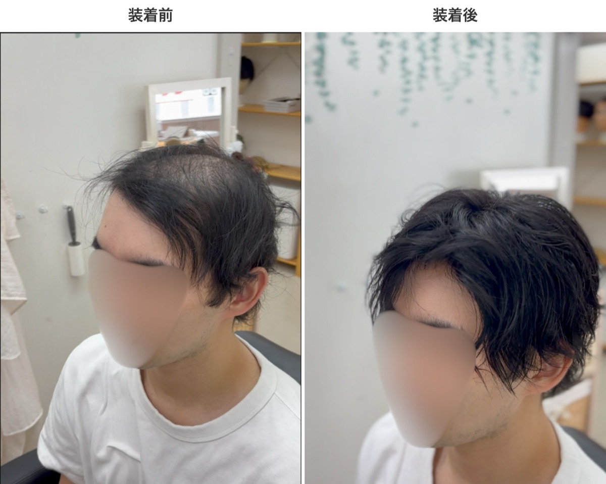 裏植えの装着前と装着後の比較（全体）。地毛の上に装着しても境目が分からない